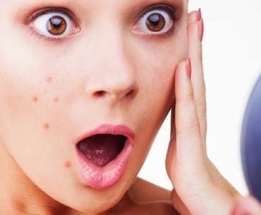 Deal With Acne